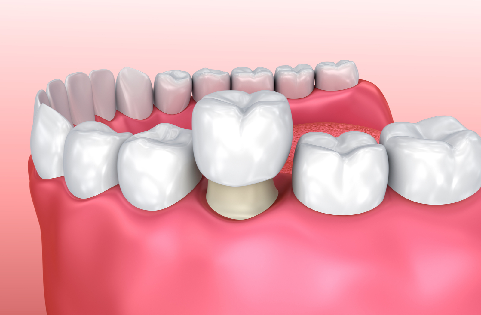 root canal metal crown