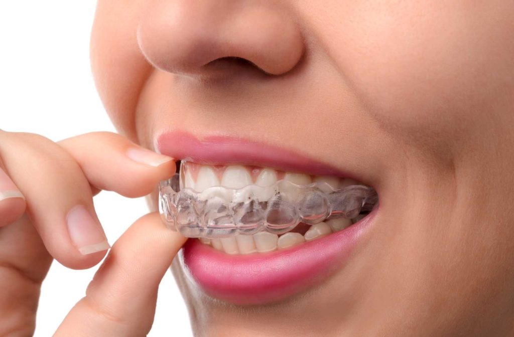 woman removing invisalign appliance while smiling