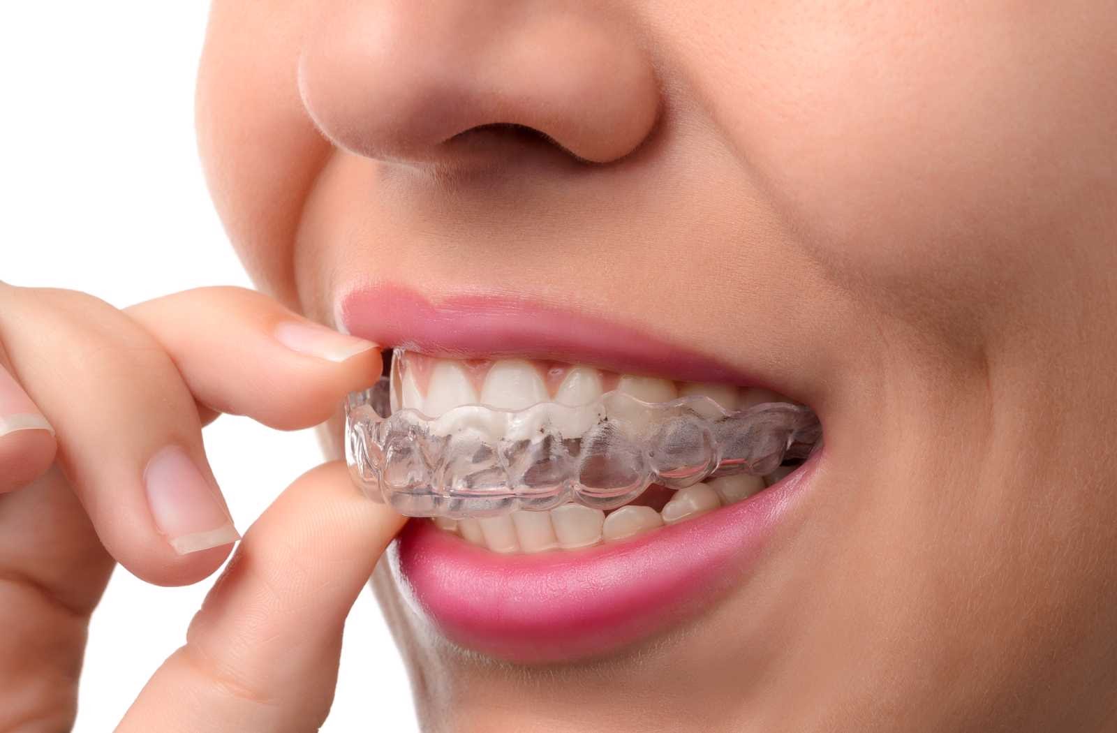 Can You Eat with Invisalign On?