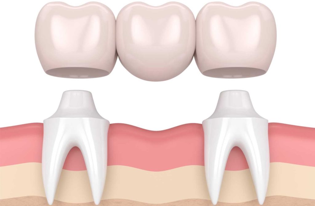 conceptual illustration of traditional dental bridge