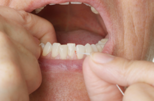 Close-up of man's mouth with bleeding gums while flossing his teeth