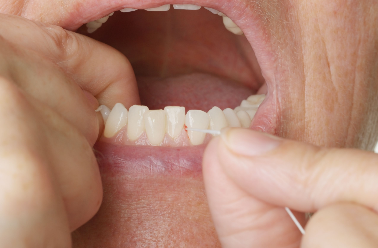 why-your-gums-are-bleeding-when-you-brush-or-floss-doug-lewis-dentistry