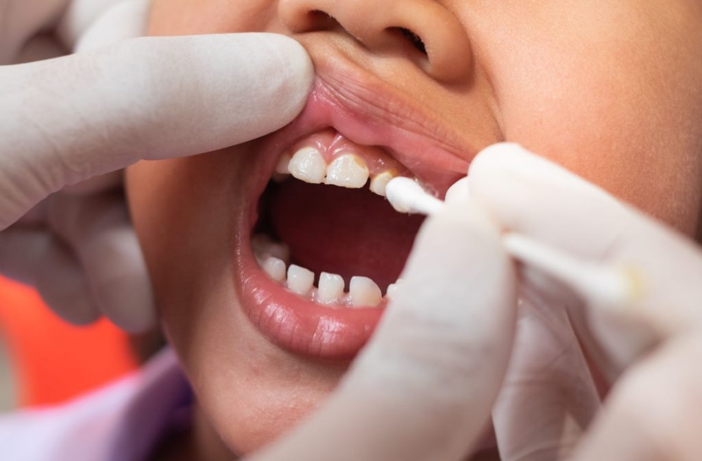 A close-up of a young boy getting fluoride applied on his teeth by the dentist