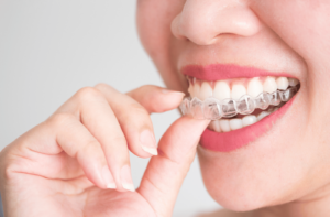 A woman places an Invisalign aligner on the top set of teeth.