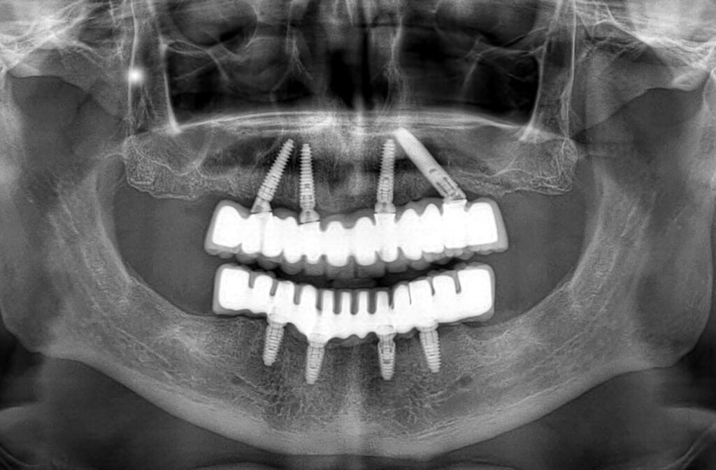 an x-ray of a dental patients mouth where you can see where they have gotten dental implants.